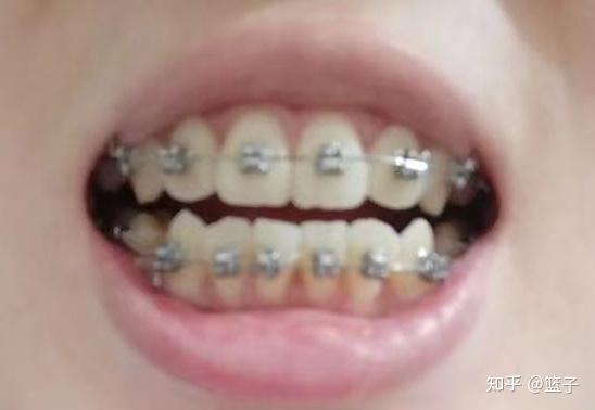 成人牙齿掉落过程视频,成人牙齿脱落现象深度解析