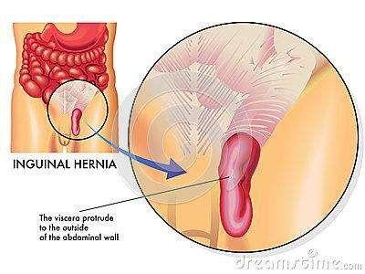 成人疝气小秘方视频大全,居家疗愈攻略汇总