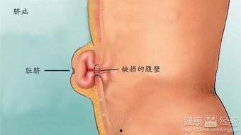 成人脐疝睡觉姿势视频