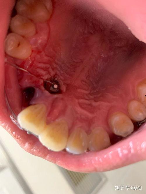 成人埋伏牙视频,视频解析与专业解读